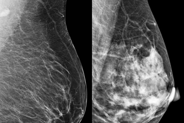 Breast Density FAQs for Referring Physicians